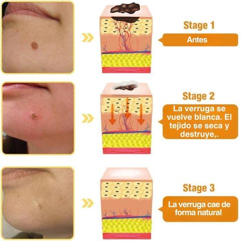 AG RECEDE- REMOVEDOR DE IMPERFECCIONES