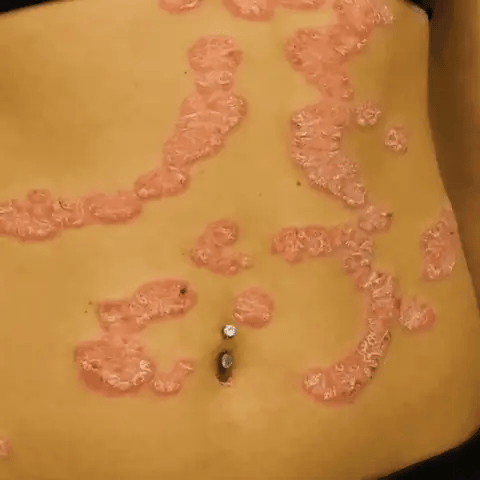Spray Para la Psoriasis